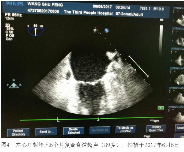 王師傅行經皮左心耳封堵術后6個月 不服用華法林了