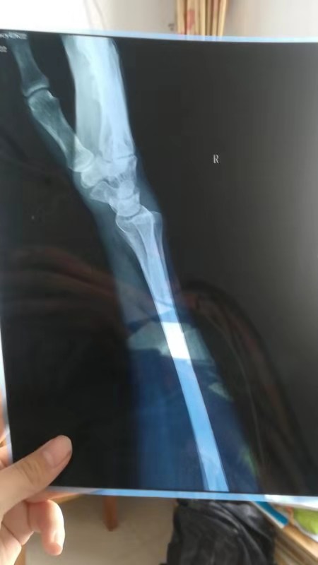 安陽沃爾瑪顧客摔成骨折商場推委扯皮